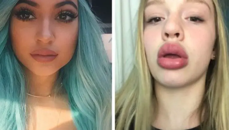 #KylieJennerChallenge: Riskanter Internet-Hype um XXL-Lippen
