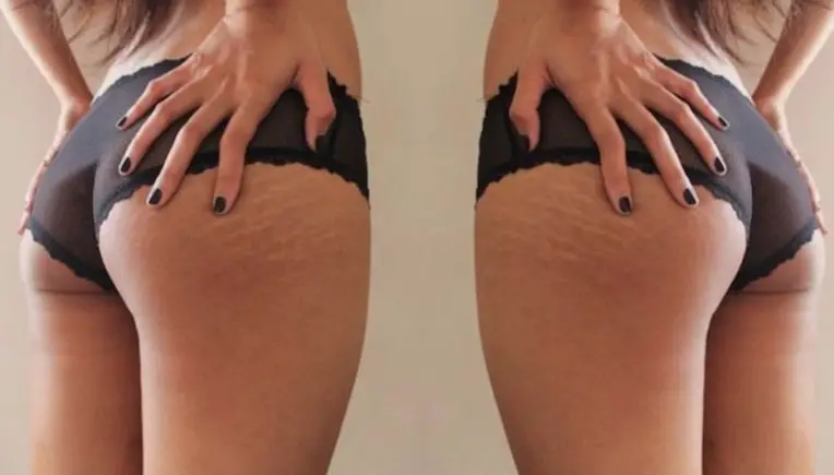 Love Yourself: Diese Hashtags sagen "Ja" zu Cellulite & Co.